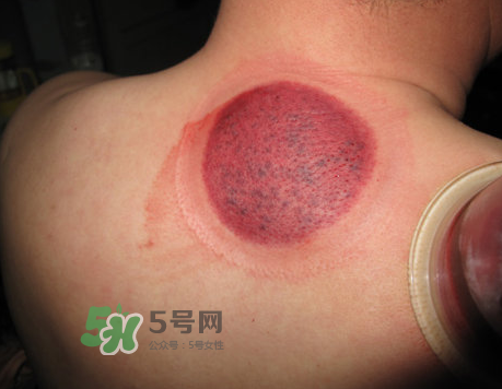 三伏天拔罐后多久可以洗澡？三伏天拔罐后注意事項(xiàng)