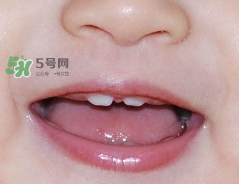 牙齒縫隙大怎么辦？牙縫大帶牙套有用嗎