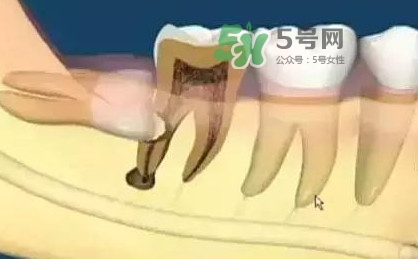 智齒是每個(gè)人都會(huì)長嗎？拔智齒能瘦臉嗎？