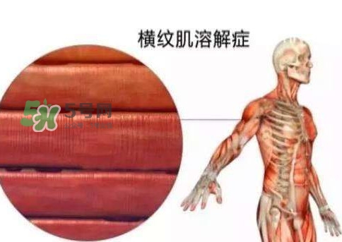 橫紋肌溶解癥會死亡嗎？橫紋肌溶解癥能活多久