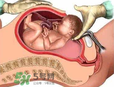 剖腹產(chǎn)比順產(chǎn)安全嗎？剖腹產(chǎn)產(chǎn)后注意事項(xiàng)？