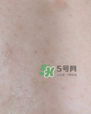 Dermatix舒痕疤痕膏有效嗎？Dermatix舒痕疤痕膏怎么用？