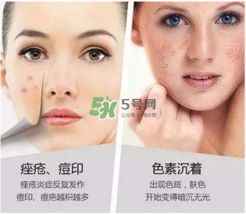 果酸換膚自己可以做嗎？果酸換膚后注意事項
