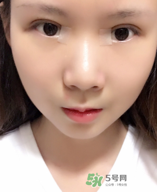 美皮護(hù)去疤效果怎么樣？美皮護(hù)有用嗎？