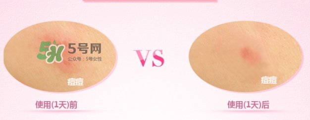 3m痘痘貼怎么用？3m痘痘貼貼多久？