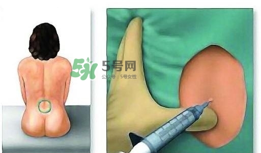 無痛分娩為什么不提倡？無痛分娩有后遺癥嗎？