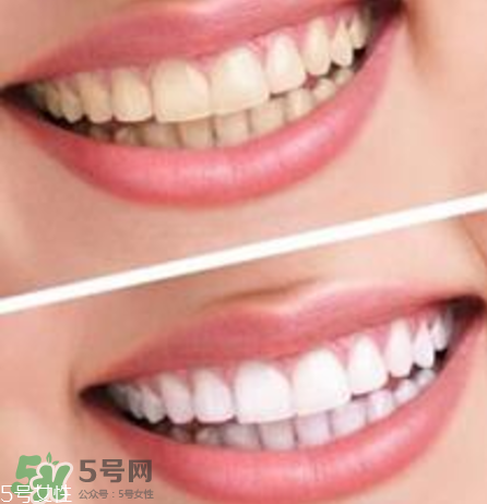 碧緹福美牙儀對(duì)牙齒有傷害嗎？碧緹福美牙儀會(huì)反彈嗎？