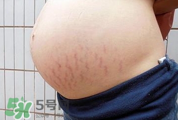 妊娠紋什么時候開始預(yù)防？妊娠紋什么時候消除？