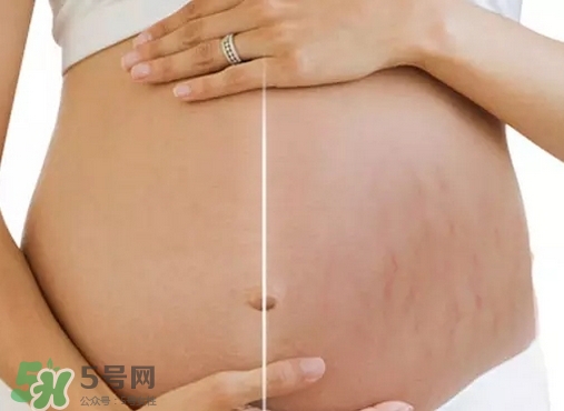 脖子上會(huì)長妊娠紋嗎？妊娠紋長在哪些地方？