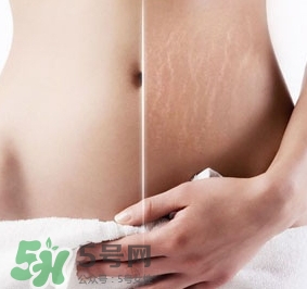 妊娠紋什么時候變白？妊娠紋產(chǎn)品什么時候用？