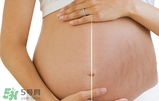 妊娠紋在左邊生男或女？怎么從妊娠紋看男女？