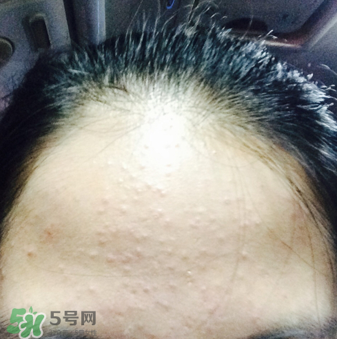 長痘長閉口怎么辦？長痘長閉口是什么原因？