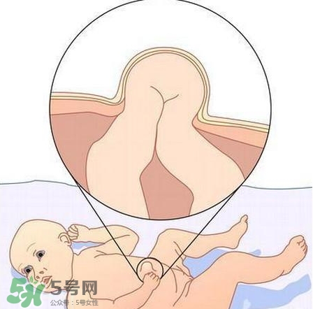 臍疝是什么？臍疝對(duì)寶寶有什么影響？