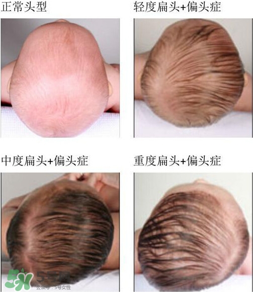 寶寶頭型是睡出來的嗎？寶寶頭型矯正最佳時(shí)間