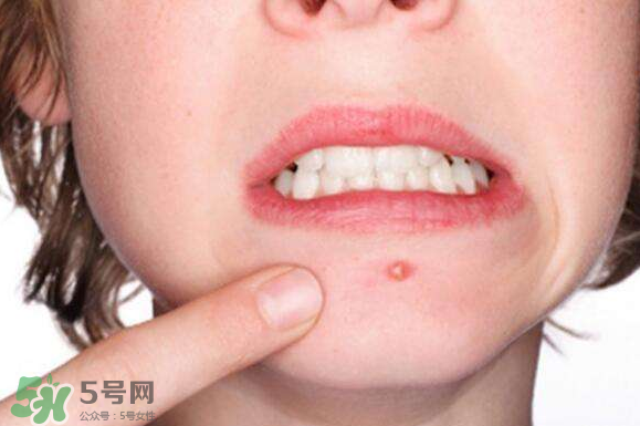 暗瘡可以擠壓嗎？油性和骯臟肌膚會容易有暗瘡嗎？