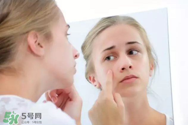 暗瘡可以擠壓嗎？油性和骯臟肌膚會容易有暗瘡嗎？