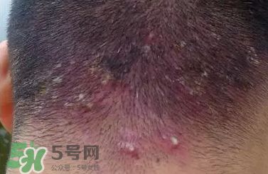 痤瘡和毛囊炎一樣嗎？痤瘡與毛囊炎區(qū)別