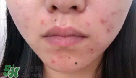 痤瘡和毛囊炎一樣嗎？痤瘡與毛囊炎區(qū)別