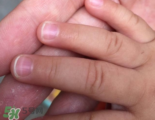 寶寶手指甲有白痕怎么回事？幼兒手指甲發(fā)白是缺鈣嗎