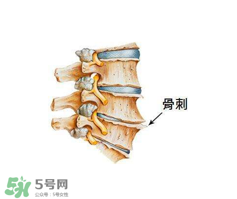 骨刺是怎么形成的？骨刺怎么治療？