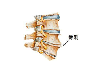 骨刺是怎么形成的？骨刺怎么治療？