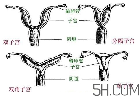 子宮畸形有哪些？子宮畸形有什么影響？
