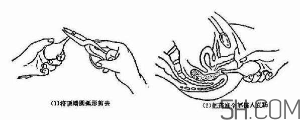 開塞露怎么用？開塞露用后多久會排便？