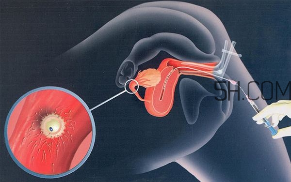 人工授精取卵子怎么取？人工授精男人怎樣取精？