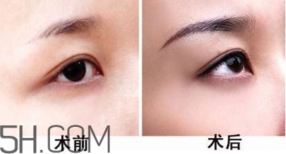 切眉手術(shù)后老得快嗎？切眉能保持多久？
