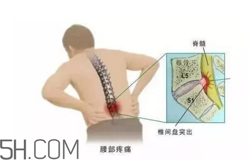 腰間盤突出是什么原因引起的？腰間盤突出是腎虛嗎