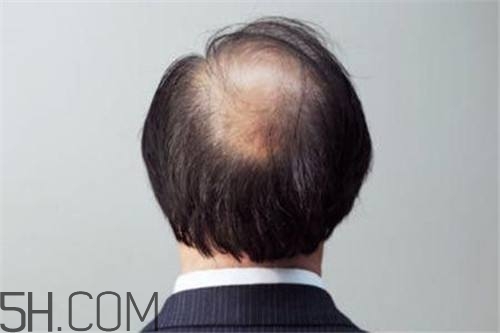 為什么男性比女性更容易脫發(fā)？什么原因導致男性脫發(fā)？