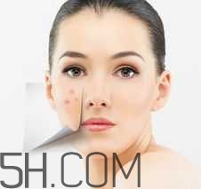濕熱型痤瘡是什么？怎么調理濕熱型痤瘡？