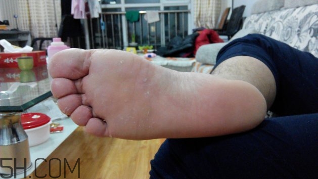 腳氣可以用酒精消毒嗎？腳氣可以用碘伏消毒嗎？