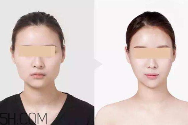 打瘦臉針可以抽煙嗎？打瘦臉針會反彈嗎？