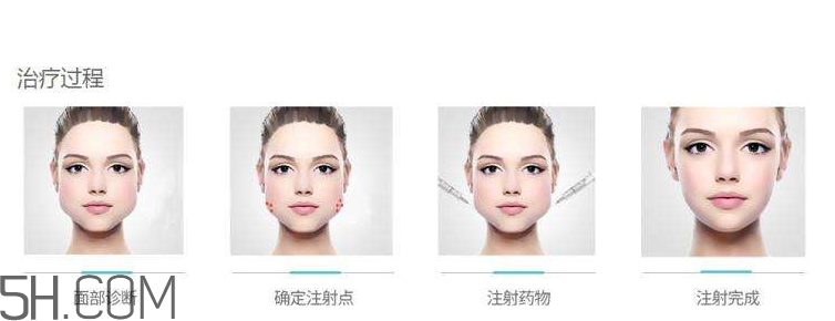 打瘦臉針可以抽煙嗎？打瘦臉針會反彈嗎？