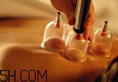 拔罐可以治療鼻炎嗎？鼻炎拔罐拔哪里？