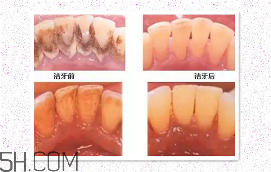 超聲波洗牙可以美白牙齒嗎？超聲波洗牙多少錢一次？