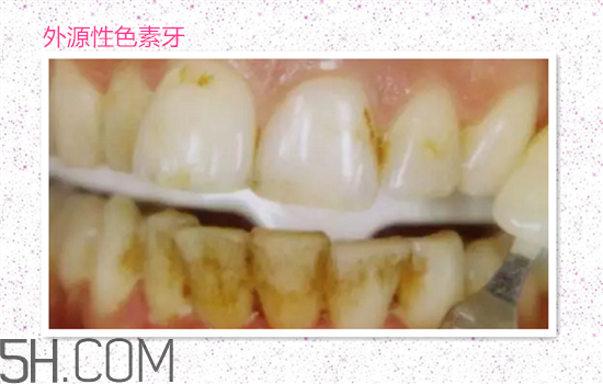 超聲波洗牙可以美白牙齒嗎？超聲波洗牙多少錢一次？