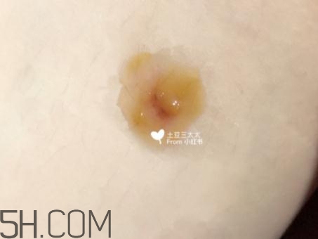 美寶濕潤(rùn)燒傷膏怎么樣？美寶濕潤(rùn)燒傷膏有用嗎？