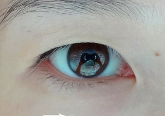 為什么會長脂肪粒？怎么消除眼睛上的脂肪粒？