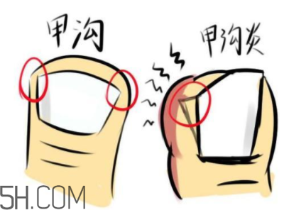 為什么容易得甲溝炎？怎么根治甲溝炎？