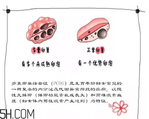 多囊卵巢生不了？多囊卵巢懷孕要看準(zhǔn)時間