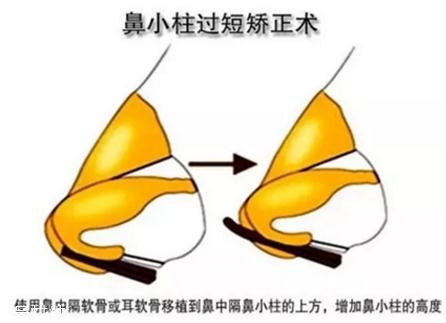 鼻小柱延長用什么材料？優(yōu)先選擇鼻中隔軟骨