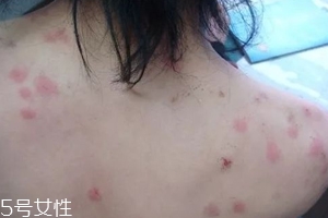 螨蟲有哪些危害？嚴(yán)重時(shí)肌膚糜爛