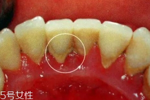 牙結(jié)石能自動(dòng)脫落嗎？除了洗牙別無(wú)他法