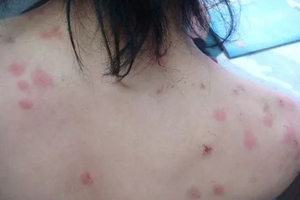 螨蟲有哪些危害？嚴(yán)重時(shí)肌膚糜爛