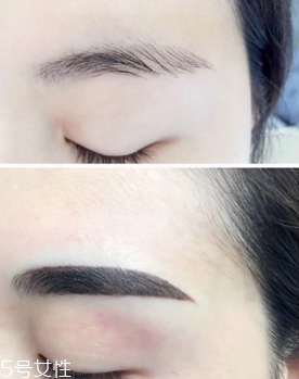 激光洗眉恢復(fù)期有疤痕怎么辦？激光洗眉毛之后正確護(hù)理方法