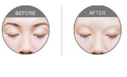 激光洗眉恢復(fù)期有疤痕怎么辦？激光洗眉毛之后正確護(hù)理方法