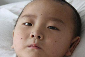 痣什么情況下會轉(zhuǎn)變?yōu)榱?？點(diǎn)痣不可取
