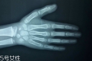 哪些人需要測骨齡？長太快警惕骨齡提前